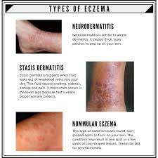 Eczema Oil