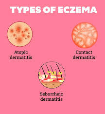 Eczema Oil