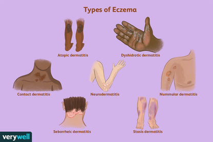 Eczema Oil