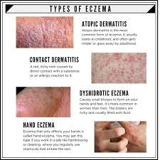 Eczema Oil